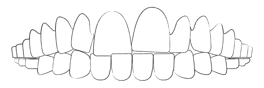 Aligner Behandlung Berlin gegen Zahnfehlstellung Zahnengstand