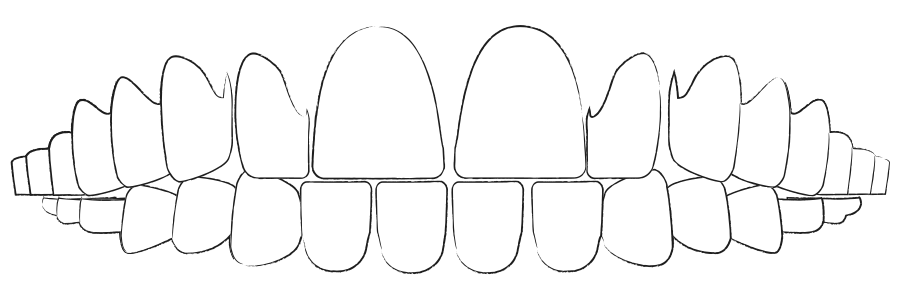 Aligner Behandlung Berlin gegen Zahnfehlstellung durch Zahnlücken