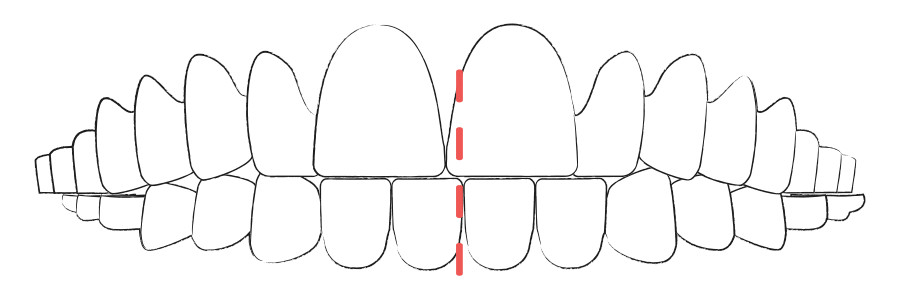 Aligner Therapie gegen Kreuzbiss