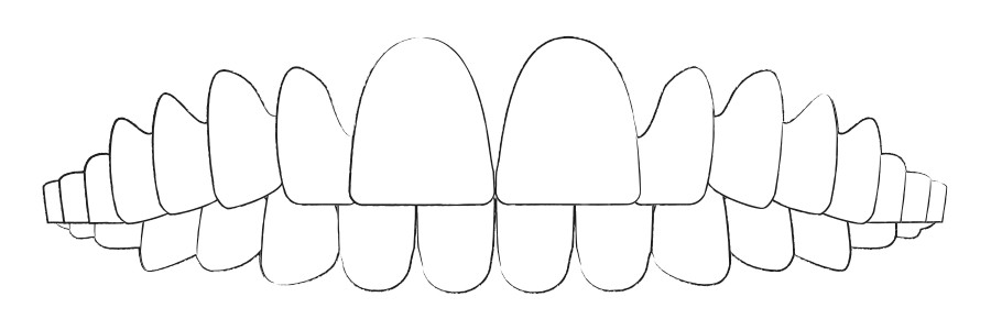 Aligner Therapie gegen Überbiss