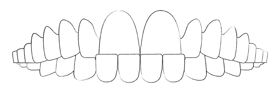 Aligner Therapie gegen Unterbiss