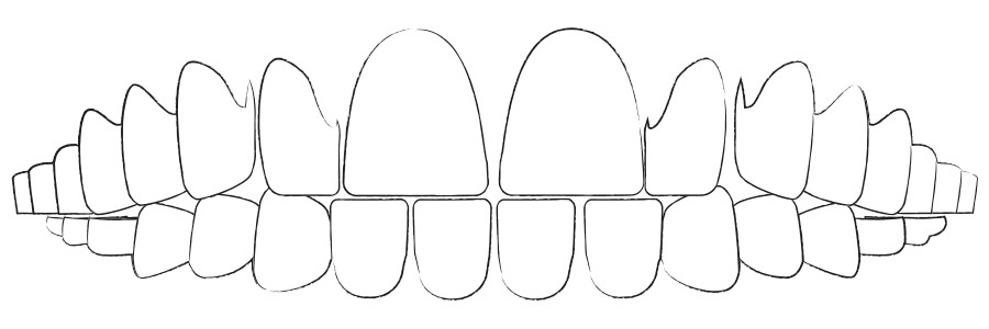 Aligner Therapie gegen Zahnlücken