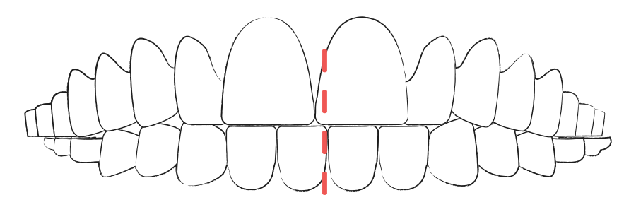 Aligner Therapie bei Kreuzbiss