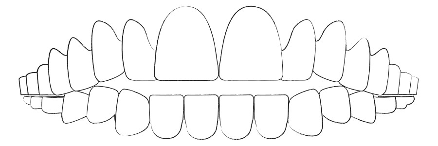 Aligner Therapie gegen offenen Biss