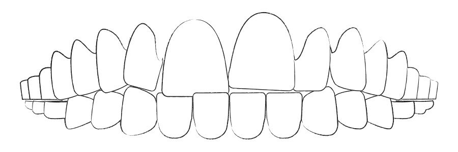 Aligner Therapie gegen Zahnengstand