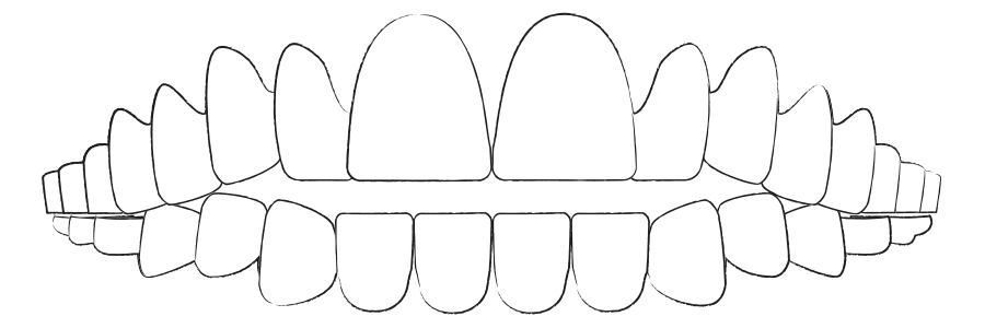 Aligner Therapie bei Offener Biss