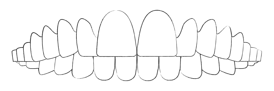 Aligner Therapie bei Überbiss