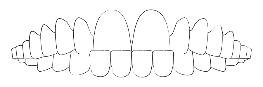 Aligner Therapie bei Unterbiss