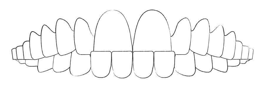 durchsichtige Zahnspangen bei Unterbiss
