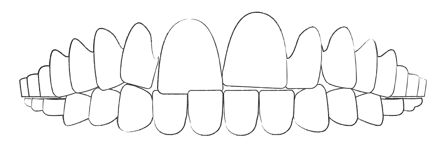 durchsichtige Zahnspangen bei Zahn-Engstand