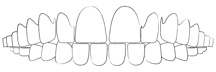 durchsichtige Zahnspangen bei Zahnlücken