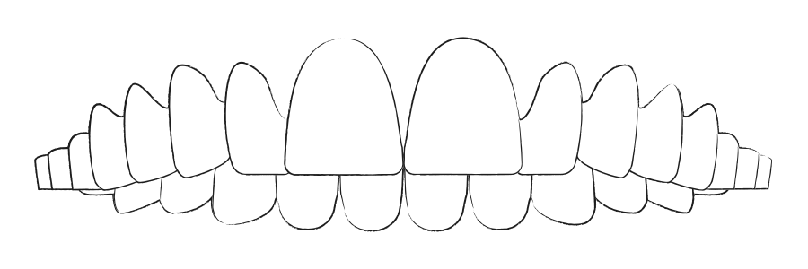 Zahnfehlstellung Tiefbiss & Deckenbiss