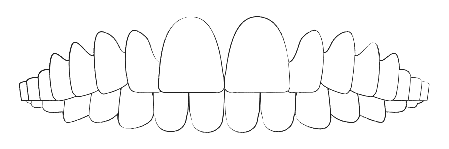 Zahnfehlstellung Überbiss