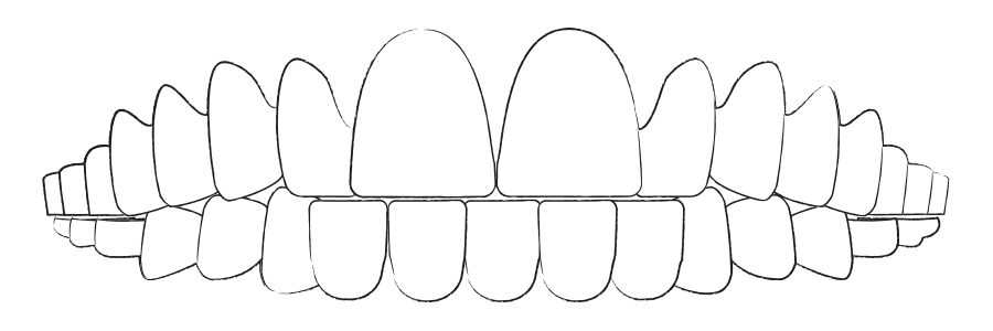 Aligner Therapie gegen Zahnüberzahl